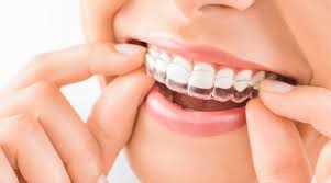 Diferencia entre brackets/alineadores invisibles