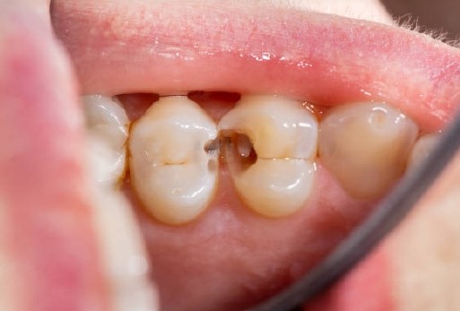 Tipos de caries